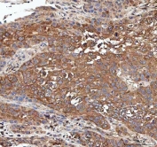 IHC staining of FFPE human esophageal squamous carcinoma tissue with PP2A antibody. HIER: boil tissue sections in pH8 EDTA for 20 min and allow to cool before testing.