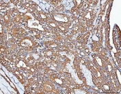 IHC staining of FFPE human thyroid cancer tissue with PP2A antibody. HIER: boil tissue sections in pH8 EDTA for 20 min and allow to cool before testing.