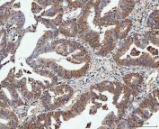 IHC staining of FFPE human colorectal adenocarcinoma tissue with PP2A antibody. HIER: boil tissue sections in pH8 EDTA for 20 min and allow to cool before testing.