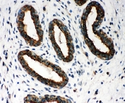 IHC-P testing of PRDX1 antibody and human breast cancer tissue. HIER: steamed with pH6 citrate buffer.