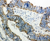 IHC-P: PRDX3 antibody testing of human intestinal cancer tissue. HIER: steamed with pH6 citrate buffer.