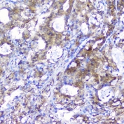 IHC staining of FFPE human stomach cancer with Peroxiredoxin 6 antibody. HIER: boil tissue sections in pH6, 10mM citrate buffer, for 20 min and allow to cool before testing.