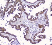 IHC staining of FFPE human ovarian cancer with Peroxiredoxin 6 antibody. HIER: boil tissue sections in pH6, 10mM citrate buffer, for 20 min and allow to cool before testing.