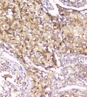 IHC staining of FFPE human lung cancer with Peroxiredoxin 6 antibody. HIER: boil tissue sections in pH6, 10mM citrate buffer, for 20 min and allow to cool before testing.