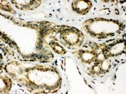 IHC staining of FFPE human breast cancer with Peroxiredoxin 6 antibody. HIER: boil tissue sections in pH6, 10mM citrate buffer, for 20 min and allow to cool before testing.