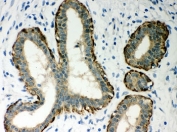 IHC-P: SERPINB5 antibody testing of human breast cancer tissue. HIER: steamed with pH6 citrate buffer.