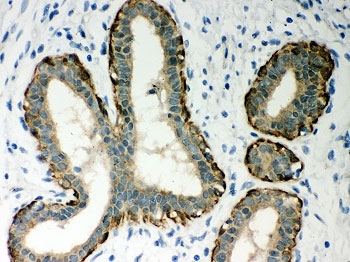 IHC-P: Ovalbumin antibody testing of human breast cancer tissue. HIER: steamed with pH6 citrate buffer.
