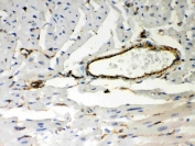IHC-P: Vimentin antibody testing of human breast cancer tissue. Required HIER: Boil the paraffin sections in 10mM citrate buffer, pH6, for 20 min.