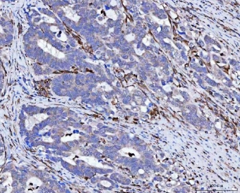 IHC staining of FFPE human colorectal adenocarcinoma tissue with Vimentin antibody. HIER: boil tissue sections in pH8 EDTA for 20 min and allow to cool before testing.