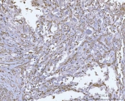 IHC staining of FFPE human invasive urothelial carcinoma tissue with Vimentin antibody. HIER: boil tissue sections in pH8 EDTA for 20 min and allow to cool before testing.