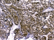 IHC staining of FFPE human liver cancer with RBP4 antibody. HIER: boil tissue sections in pH6, 10mM citrate buffer, for 20 min and allow to cool before testing.