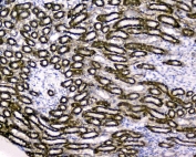 IHC staining of FFPE human liver cancer with RBP4 antibody. HIER: boil tissue sections in pH6, 10mM citrate buffer, for 20 min and allow to cool before testing.