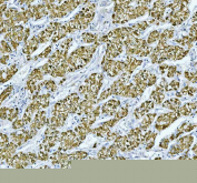 IHC staining of FFPE human liver cancer tissue with RBP4 antibody, HRP-labeled secondary and DAB substrate. HIER: boil tissue sections in pH8 EDTA for 20 min and allow to cool before testing.