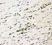 IHC-P testing of RUNX3 antibody and human intestine cancer tissue. HIER: boil tissue sections in pH8 EDTA for 20 min and allow to cool before testing.