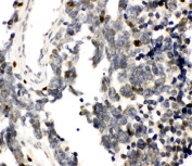 IHC-P testing of RUNX3 antibody and human lung cancer tissue. HIER: boil tissue sections in pH8 EDTA for 20 min and allow to cool before testing.