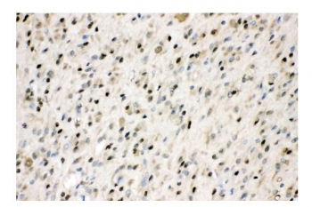 IHC staining of FFPE human glioma tissue with VCP antibody. HIER: boil tissue sections in pH8 EDTA for 20 min and allow to cool before testing.