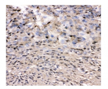 IHC staining of FFPE human meningioma tissue with VCP antibody. HIER: boil tissue sections in pH8 EDTA for 20 min and allow to cool before testing.
