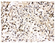 IHC staining of FFPE human glioma tissue with VCP antibody. HIER: boil tissue sections in pH8 EDTA for 20 min and allow to cool before testing.