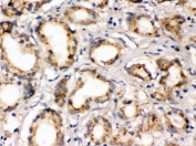 IHC testing of FFPE human prostate cancer tissue with FXYD1 antibody. HIER: Boil the paraffin sections in pH 6, 10mM citrate buffer for 20 minutes and allow to cool prior to staining.