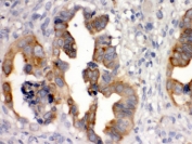 IHC testing of FFPE human intestinal cancer tissue with SULT2B1 antibody. HIER: Boil the paraffin sections in pH 6, 10mM citrate buffer for 20 minutes and allow to cool prior to staining.