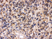 IHC testing of FFPE human glioma tissue with FE65 antibody. HIER: Boil the paraffin sections in pH 6, 10mM citrate buffer for 20 minutes and allow to cool prior to staining.