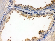 IHC testing of FFPE human prostate cancer with BMPR1B antibody. HIER: Boil the paraffin sections in pH 6, 10mM citrate buffer for 20 minutes and allow to cool prior to staining.