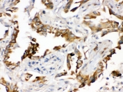 IHC testing of FFPE human lung cancer tissue with PGRMC1 antibody. HIER: Boil the paraffin sections in pH 6, 10mM citrate buffer for 20 minutes and allow to cool prior to staining.