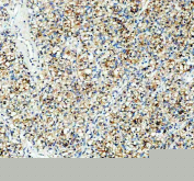 IHC staining of FFPE human renal cancer tissue with PGRMC1 antibody, HRP-secondary and DAB substrate. HIER: boil tissue sections in pH8 EDTA for 20 min and allow to cool before testing.