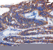 IHC staining of FFPE human colon cancer tissue with PGRMC1 antibody, HRP-secondary and DAB substrate. HIER: boil tissue sections in pH8 EDTA for 20 min and allow to cool before testing.