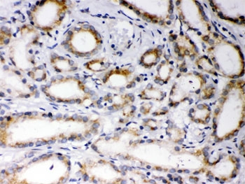 IHC testing of FFPE human prostate cancer tissue with EBAG9 antibody. HIER: Boil the paraffin sections in pH 6, 10mM citrate buffer for 20 minutes and allow to cool prior to staining.