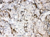 IHC testing of FFPE human liver cancer tissue with NTCP antibody. HIER: Boil the paraffin sections in pH 6, 10mM citrate buffer for 20 minutes and allow to cool prior to staining.