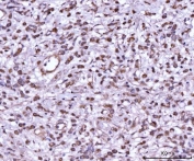 IHC testing of FFPE human testis cancer tissue with MKK7 antibody. HIER: Boil the paraffin sections in pH8 EDTA for 20 minutes and allow to cool prior to staining.