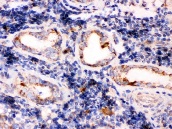 IHC testing of FFPE human lung cancer tissue with TPP1 antibody. HIER: Boil the paraffin sections in pH 6, 10mM citrate buffer