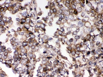 IHC testing of FFPE human lung cancer tissue with AIM2 antibody. HIER: Boil the paraffin sections in pH 6, 10mM citrate buffer for 20 minutes and allow to cool prior to staining.