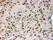 IHC testing of FFPE human glioma tissue with PPP1R12A antibody. HIER: Boil the paraffin sections in pH 6, 10mM citrate buffer for 20 minutes and allow to cool prior to staining.