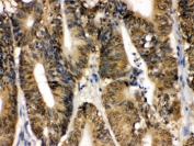 IHC testing of FFPE human intestinal cancer with SAPK4 antibody. HIER: Boil the paraffin sections in pH 6, 10mM citrate buffer for 20 minutes and allow to cool prior to staining.