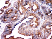 IHC testing of FFPE human intestinal cancer tissue with SPTLC1 antibody. HIER: Boil the paraffin sections in pH 6, 10mM citrate buffer for 20 minutes and allow to cool prior to staining.
