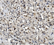 IHC testing of FFPE human stomach cancer with OGT antibody. HIER: Boil the paraffin sections in pH8 EDTA for 20 minutes and allow to cool prior to staining.