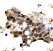 IHC testing of FFPE human pancreatic cancer with OGT antibody. HIER: Boil the paraffin sections in pH8 EDTA for 20 minutes and allow to cool prior to staining.