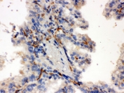 IHC testing of FFPE human kidney cancer tissue with CYP27B1 antibody. HIER: Boil the paraffin sections in pH 6, 10mM citrate buffer for 20 minutes and allow to cool prior to staining.