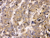IHC testing of FFPE human lung cancer tissue with PDPK1 antibody. HIER: Boil the paraffin sections in pH 6, 10mM citrate buffer for 20 minutes and allow to cool prior to staining.