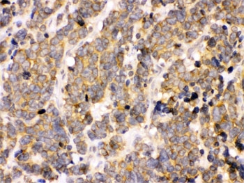 IHC testing of FFPE human lung cancer tissue with PDPK1 antibody. HIER: Boil the paraffin sections in pH 6, 10mM citrate buffer for 20 minutes and allow to cool prior to staining.