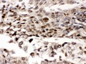 IHC testing of FFPE human lung cancer tissue with PRKAB2 antibody. HIER: Boil the paraffin sections in pH 6, 10mM citrate buffer for 20 minutes and allow to cool prior to staining.