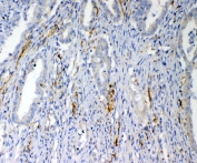 IHC testing of FFPE human colon cancer tissue with VEGFD antibody at 1ug/ml. Required HIER: steam section in pH6 citrate buffer for 20 min and allow to cool prior to testing.