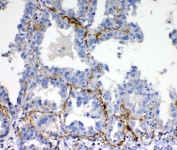 IHC testing of FFPE human lung cancer tissue with VEGFD antibody at 1ug/ml. Required HIER: steam section in pH6 citrate buffer for 20 min and allow to cool prior to testing.