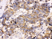 IHC testing of FFPE human lung cancer tissue with OPA1 antibody. HIER: Boil the paraffin sections in pH 6, 10mM citrate buffer for 20 minutes and allow to cool prior to staining.