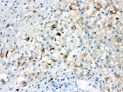 IHC testing of FFPE human appendicitis tissue with TLR5 antibody. HIER: Boil the paraffin sections in pH 6, 10mM citrate buffer for 20 minutes and allow to cool prior to staining.