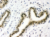 IHC testing of FFPE human breast cancer with p95 NBS1 antibody. HIER: Boil the paraffin sections in pH 6, 10mM citrate buffer for 20 minutes and allow to cool prior to staining.