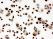 ICC testing of FFPE human SW480 cells with p95 NBS1 antibody. HIER: Boil the paraffin sections in pH 6, 10mM citrate buffer for 20 minutes and allow to cool prior to staining.