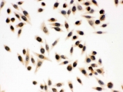 ICC testing of FFPE human SMMC-7781 cells with p95 NBS1 antibody. HIER: Boil the paraffin sections in pH 6, 10mM citrate buffer for 20 minutes and allow to cool prior to staining.